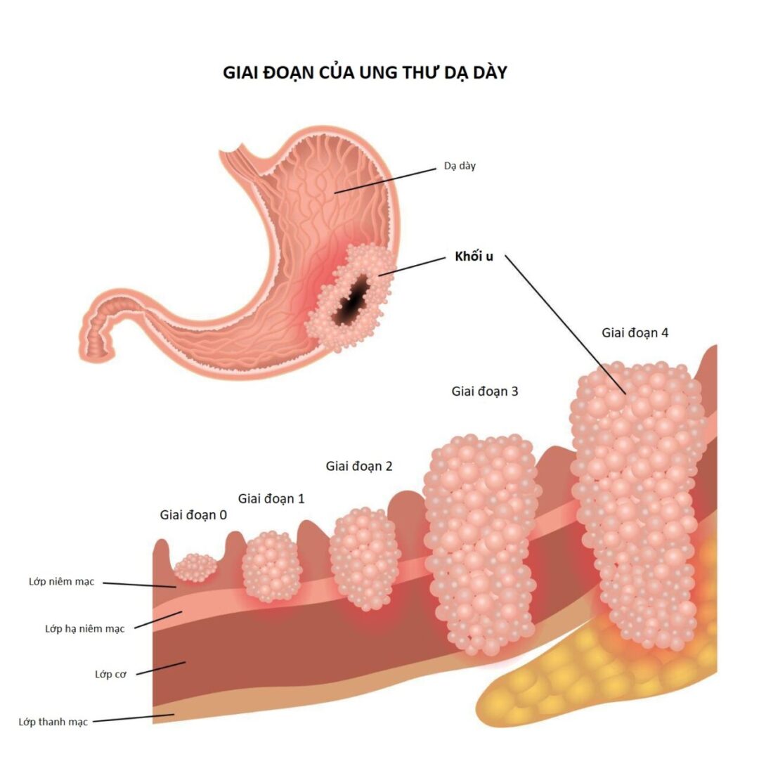 Các loại dược liệu trị loét dạ dày
