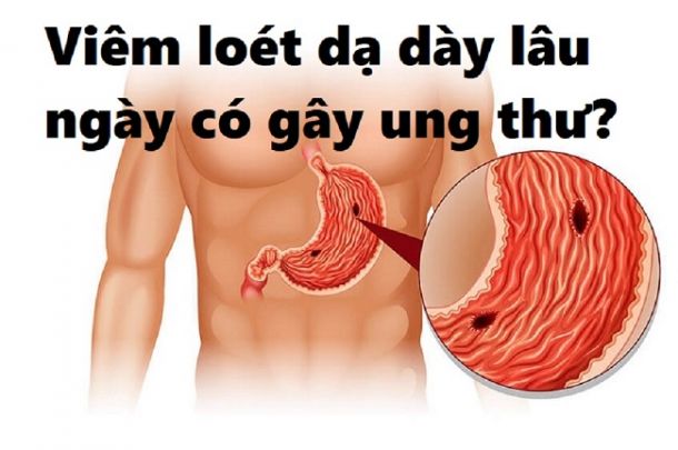 Hệ lụy của tự điều trị dạ dày