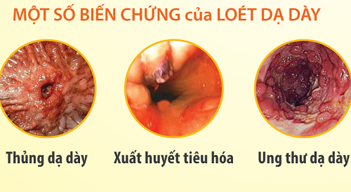 Lối sống lành mạnh phòng loét dạ dày