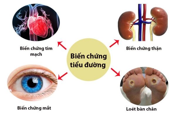 Hình minh họa biến chứng tiểu đường