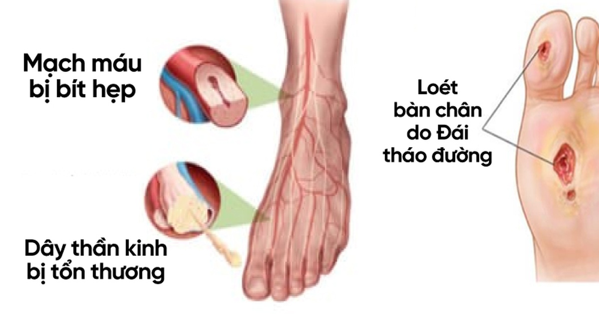 Tác hại của biến chứng tiểu đường