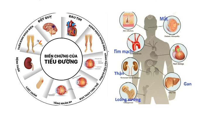 Biến chứng nguy hiểm của tiểu đường