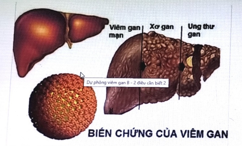 Tác hại của biến chứng viêm gan