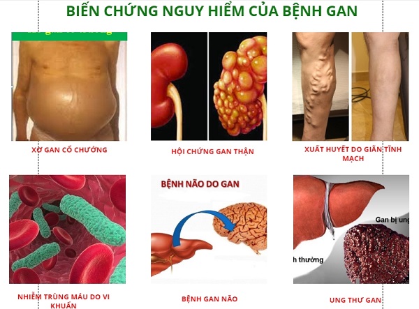 Hỗ trợ phòng ngừa biến chứng viêm gan bằng thảo dược