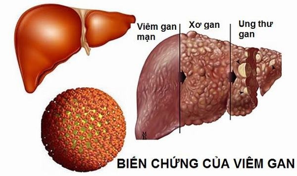 Người bệnh viêm gan cần kiểm soát và phòng ngừa biến chứng