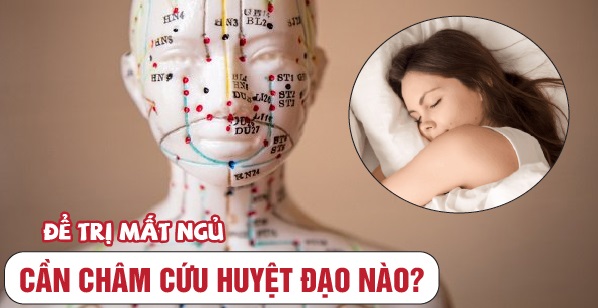 Châm cứu giúp thư giãn não bộ, cải thiện chất lượng giấc ngủ