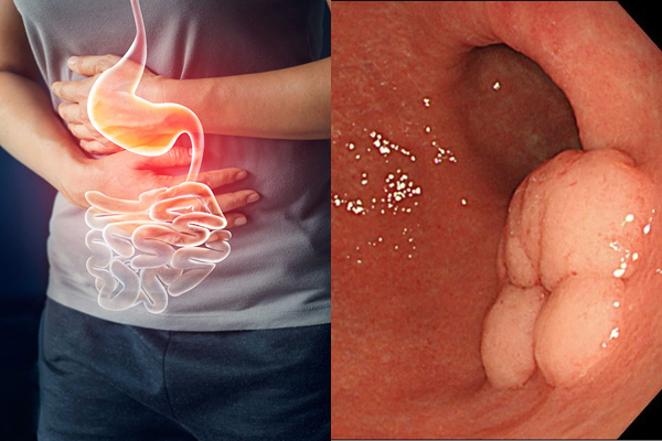 Tìm hiểu kỹ càng khi sử dụng thuốc nam trong trị bệnh dạ dày