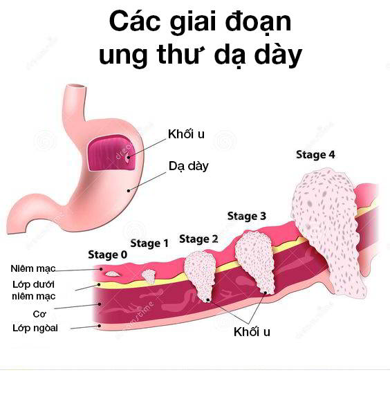 Cảnh báo rủi ro tự ý dùng thuốc nam trị ung thư dạ dày