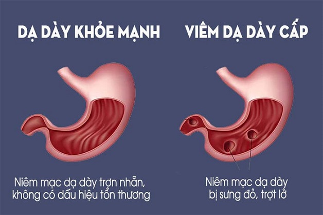 Sử dụng thảo dược thiên nhiên cho dạ dày