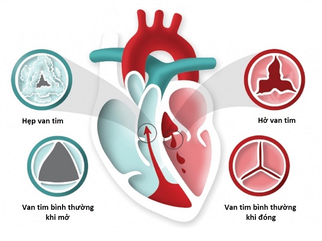 Liệt kê các nguyên nhân hàng đầu gây tổn thương van tim gây hở vĩnh viễn hoặc tạm thời