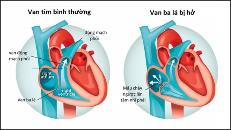 Giải pháp điều trị, biện pháp bảo vệ tim - thảo dược và kiểm soát bệnh nền