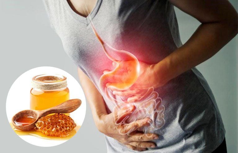 Rủi ro khi tự ý dùng mẹo dân gian cho đau dạ dày
