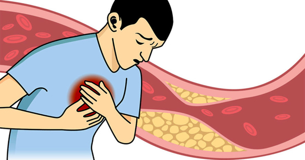 Các dạng cholesterol và tác hại lên tim mạch