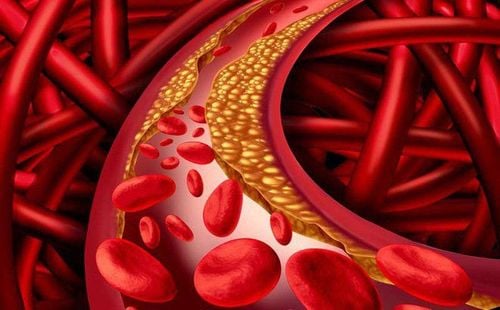 Sự hình thành xơ vữa và rủi ro nhồi máu cơ tim