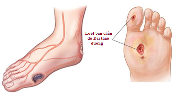 Khái quát các loại tiểu đường