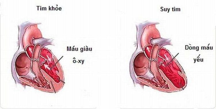 Những yếu tố nguy cơ thường gặp của bệnh suy tim
