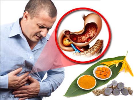 Nghệ và dược liệu hỗ trợ điều trị viêm loét dạ dày