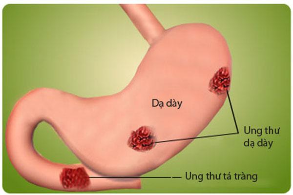 Viêm loét dạ dày tiến triển thành ung thư