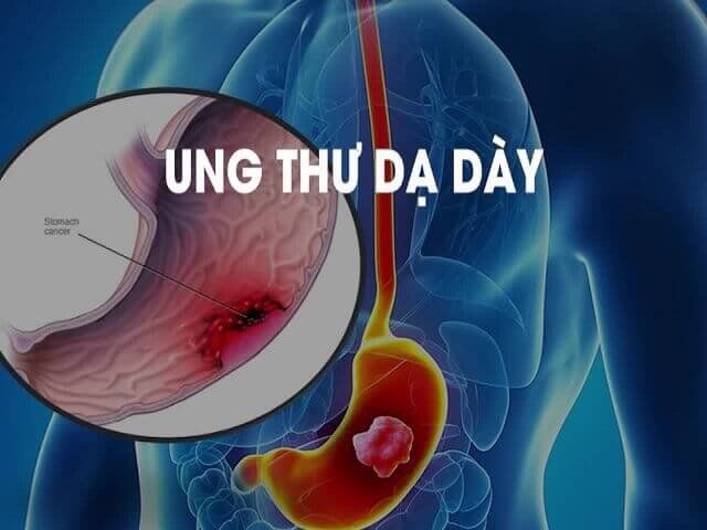 Thuốc nam hỗ trợ dạ dày: niềm tin & thực tiễn