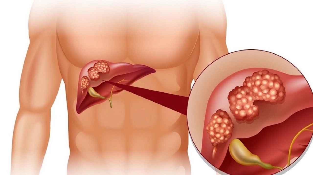Các yếu tố lây truyền viêm gan D trong cộng đồng