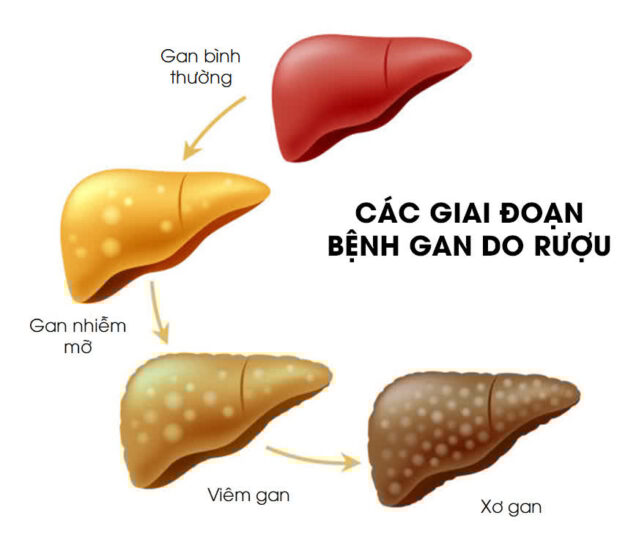 Lời khuyên an toàn khi điều trị viêm gan do rượu bia
