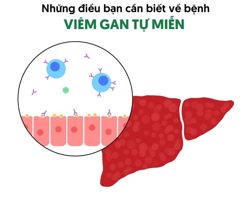Tìm hiểu về viêm gan tự miễn