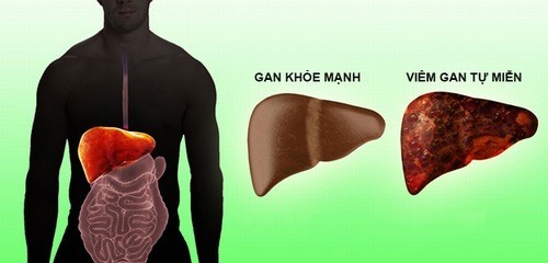 Viêm gan tự miễn có nguy hiểm không?
