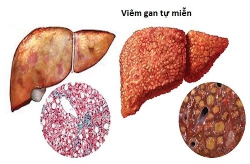 Điều trị và phòng ngừa viêm gan tự miễn