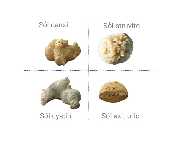 Bảng phân biệt các loại sỏi thận