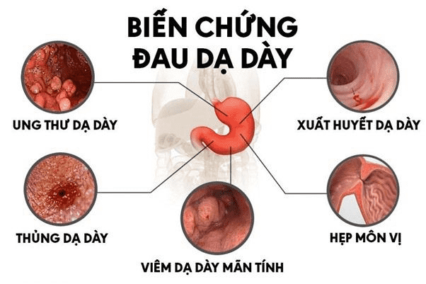 Biến chứng dạ dày và niềm tin vào thảo dược