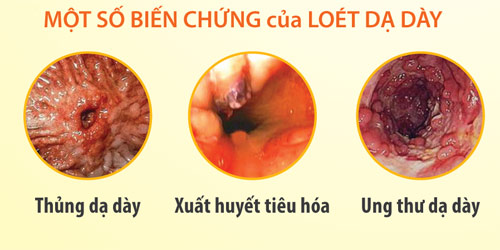 Thảo dược hỗ trợ điều trị viêm loét dạ dày