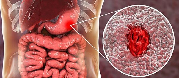 Nguy cơ khi tự ý dùng thảo dược trị viêm loét dạ dày