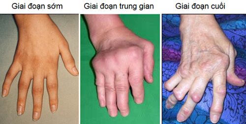 Hình ảnh minh hoạ về biến chứng viêm khớp dạng thấp