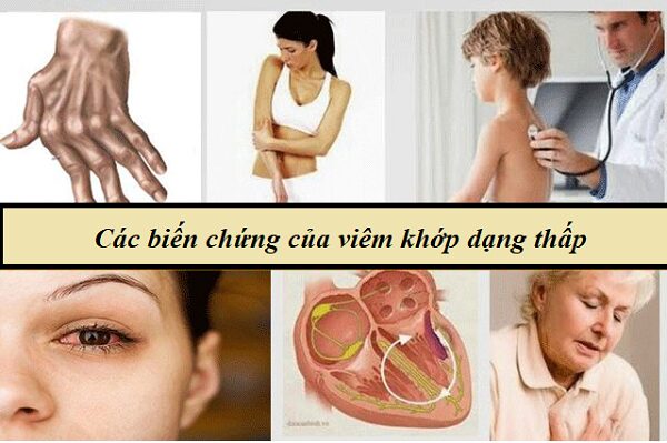 Vì sao cần thận trọng khi tự ý dùng thuốc Nam trị viêm khớp dạng thấp?