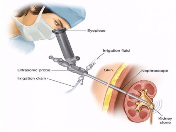 Chi phí điều trị bệnh sỏi thận tại Việt Nam
