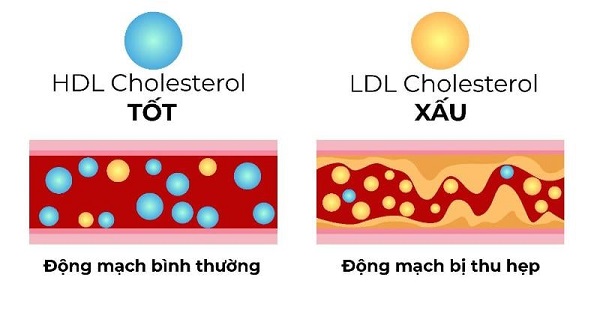 Minh họa về phân loại cholesterol tốt và xấu