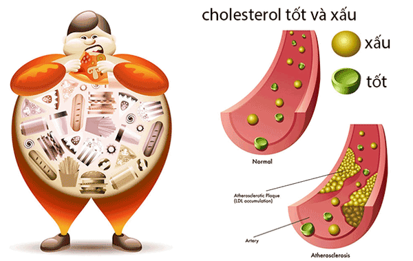 Biểu đồ về mối liên hệ giữa cholesterol xấu (LDL), tốt (HDL) và mạch máu