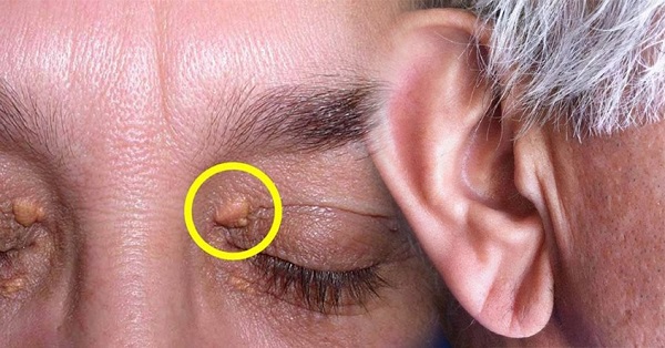 Nguyên nhân mỡ máu, vai trò di truyền và lối sống