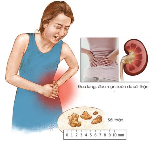 Những dấu hiệu sớm của sỏi thận