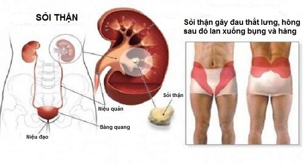 Dấu hiệu nhận biết sớm sỏi thận