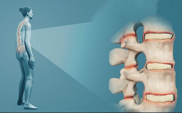 phân biệt dấu hiệu viêm cột sống dính khớp