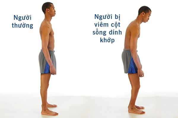 hệ lụy viêm cột sống dính khớp khi điều trị sai cách