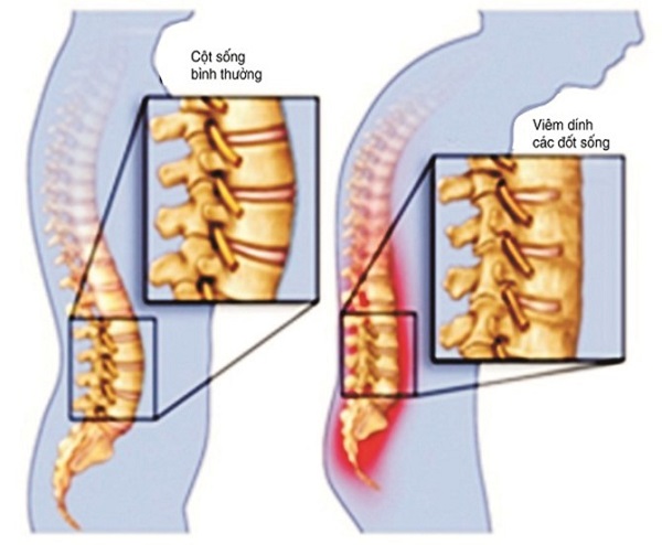 giải pháp hỗ trợ điều trị viêm cột sống dính khớp