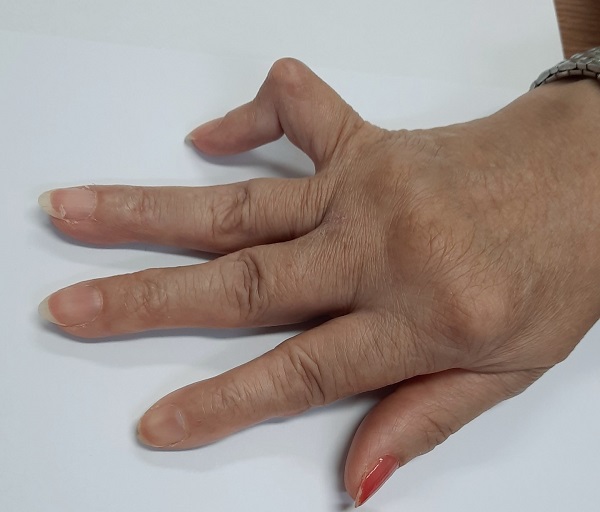 Dấu hiệu nhận biết bệnh viêm khớp dạng thấp
