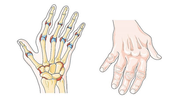So sánh các triệu chứng bệnh viêm khớp