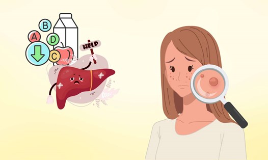 Gan khoẻ mạnh giúp cơ thể thanh lọc tự nhiên - Detox gan tự nhiên