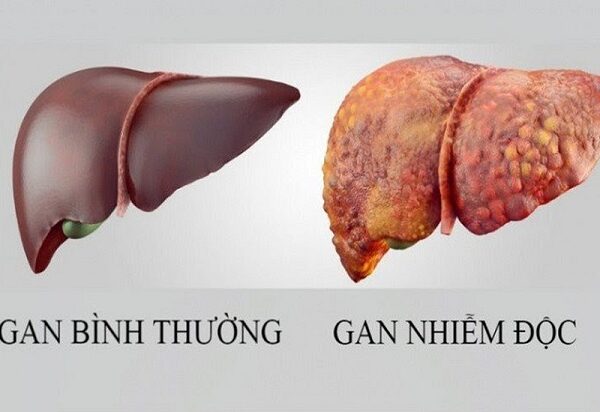 gan nhiễm độc, chức năng thải độc bị suy giảm
