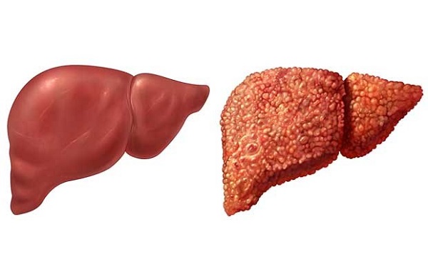 triệu chứng gan nhiễm độc, dấu hiệu nóng gan