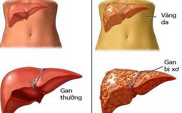 nóng gan, hậu quả và biến chứng