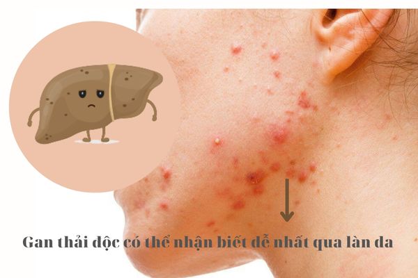 Giải pháp thải độc gan an toàn, bền vững bằng thảo dược thiên nhiên